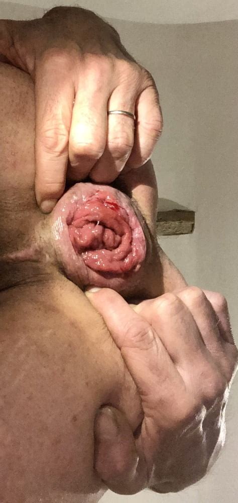 Anal Dilation After Big Insertion Pics XHamster