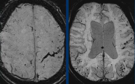 The Radiology Assistant Non Traumatic Intracranial Hemorrhage