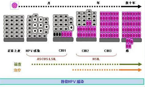 一起来了解宫颈癌筛查 子宫疾病 妇科微创网