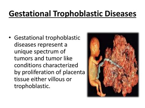 Gestational Trophoblastic Diseases