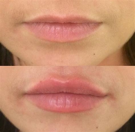 Lip Augmentation Before And After Mda