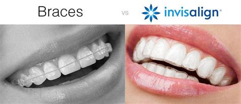 5 Advantages Of Invisalign David H Lee Dds Msd Board Certified