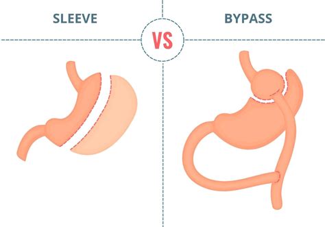 Qual a diferença entre cirurgia bariátrica Sleeve e Bypass IBEMC Dr