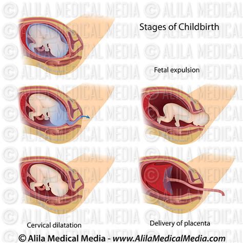 Alila Medical Media | Stages of childbirth diagram. | Medical illustration