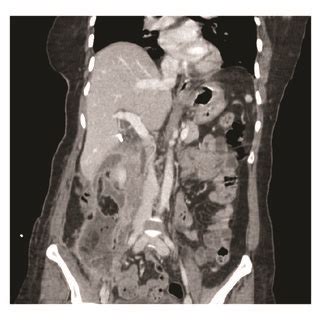 Coronal abdominal CT scan image showing retroperitoneal abscess. | Download Scientific Diagram