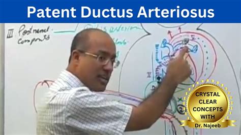 Patent Ductus Arteriosus Pda Youtube