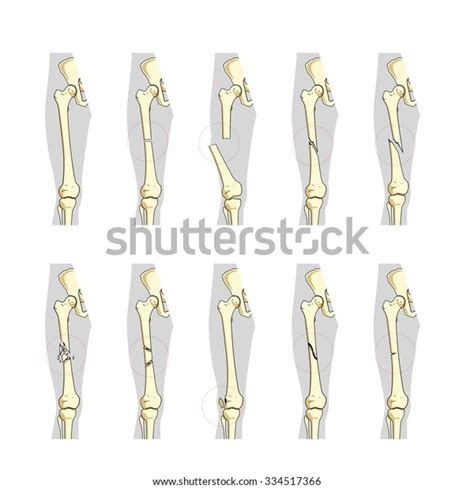 Types Bone Fractures Medical Skeleton Anatomy 스톡 벡터 로열티 프리 334517366