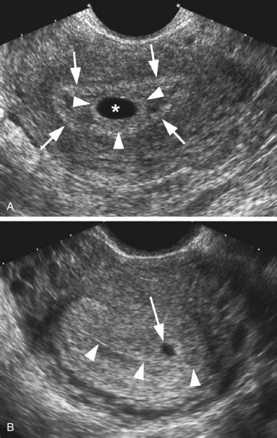 Ultrasound Of The Early First Trimester Radiology Key