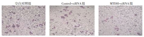 Mtdh基因下调抑制人乳腺癌mda Mb 453细胞增殖同黏附和迁移的研究