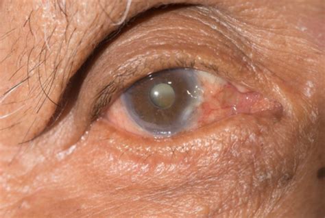 Cataract Treatment Without Surgery Know Your Options