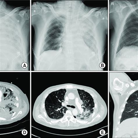 Left Pulmonary Artery Lpa Obstruction Due To Kinking A A Chest