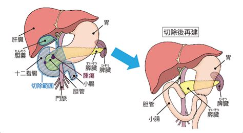 2胆道がんの治療について｜がんの先進医療｜蕗書房