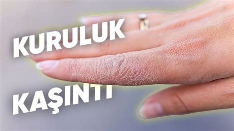 Egzama Olarak Bilinen Atopik Dermatit Nedir Nasıl Geçer