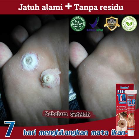 Jual Obat Mata Ikan Pada Telapak Kaki Perontok Mata Ikan Di Telapak