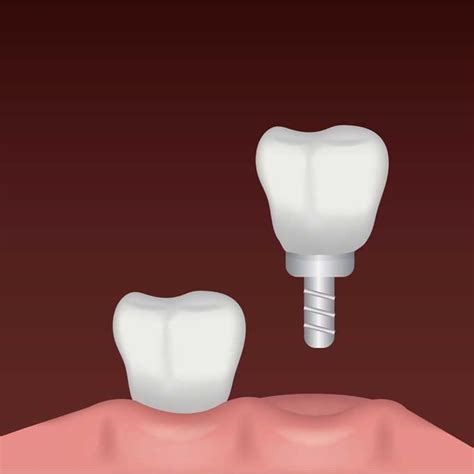 Wisdom Tooth Cavity Symptoms And Treatment Options