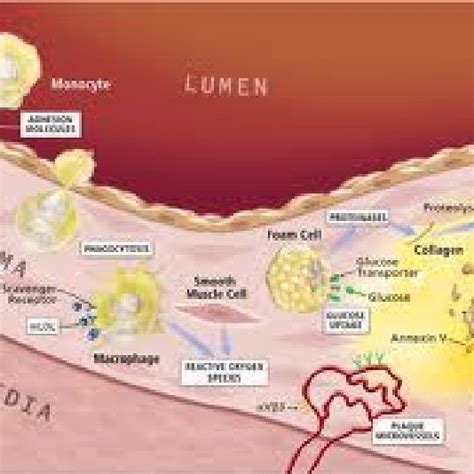 Schematic Presentation Of The Development Of Atherosclerotic Plaque In