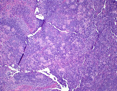 Toxoplasmosis Brain Pathology