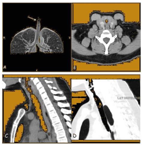 Computed Tomography CT A CT Volume Rendering Technique VRT The