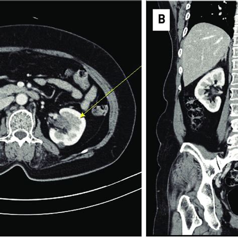 A Axial Kidney Dynamic Computed Tomography Ct Images Show A Poorly