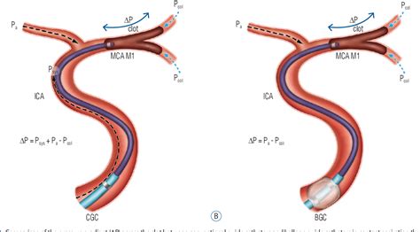 PDF Role Of Balloon Guide Catheter In Modern Endovascular