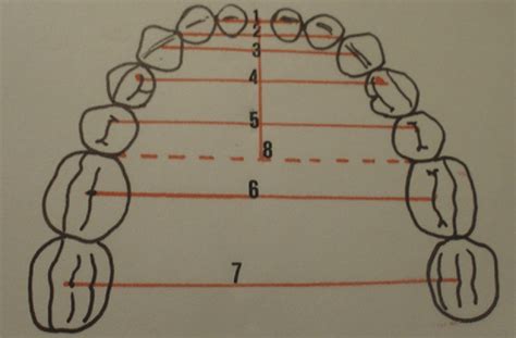 Anatomic Landmarks Used For Measurements On Dental Casts 1 Distance