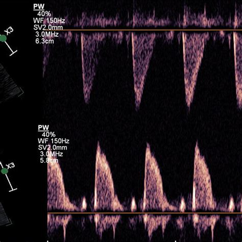 A Blood Flow Velocity Waveforms At The Level Of The Aortic Valve At