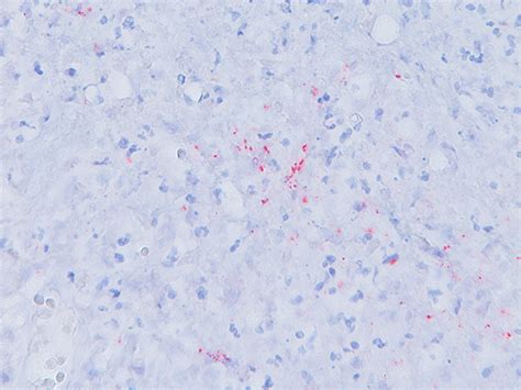 Treponema Pallidum Antibody - Bicoare Medical