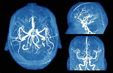 Aneurisma Otak Gejala Penyebab Diagnosis Pengobatan