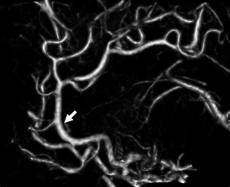 Epidermal Nevus Syndrome With Azygos Anterior Cerebral Artery