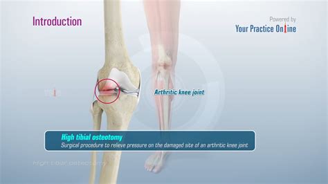 High Tibial Osteotomy Procedure