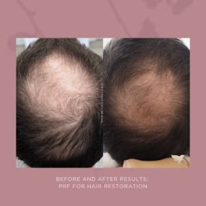 9 Things To Know About PRF Platelet Rich Fibrin For Hair Restoration