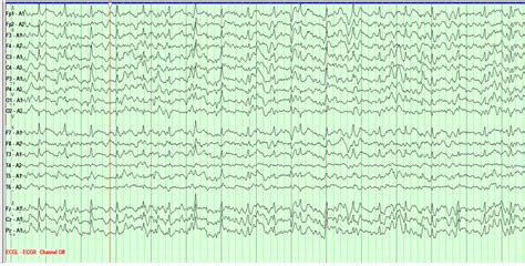 Learn To Read Eeg With Practice Questions Nowyouknow Neuro