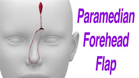 Paramedian Forehead Flap Before And After