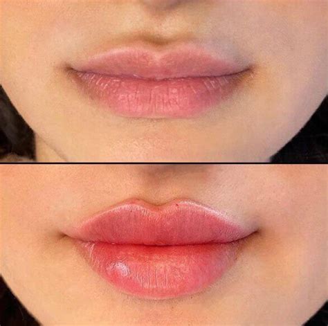 Top 10 Lip Filler Shapes To Enhance Your Natural Beauty Leva Medical