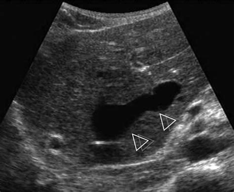 Budd Chiari Syndrome Ultrasound