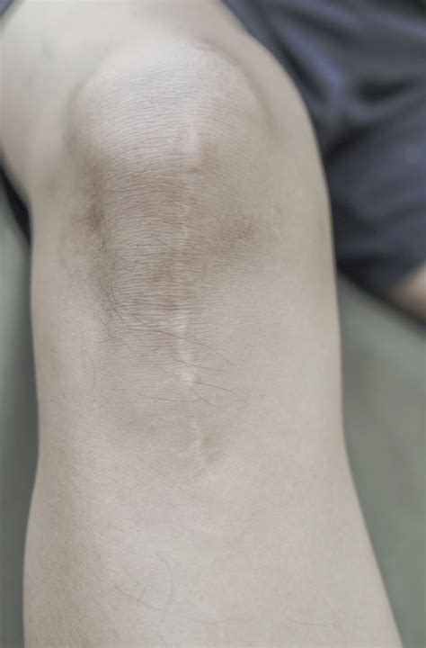 6 Ways To Minimize Post Surgical Scars Dr Rizk