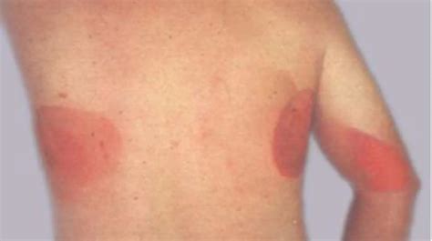 Discolored Skin Patches: Pictures, Causes, and Treatments