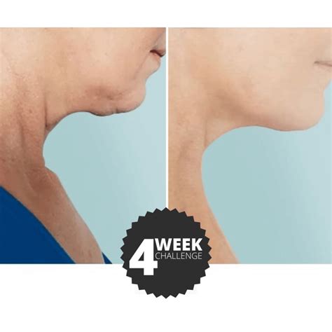 Bodcor Body Contouring For Neck Chin And Jawline Painless