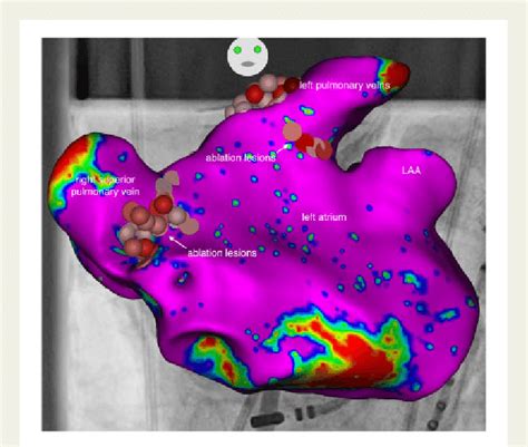 Electroanatomical Map Showing The Left Atrium Anterior Posterior View