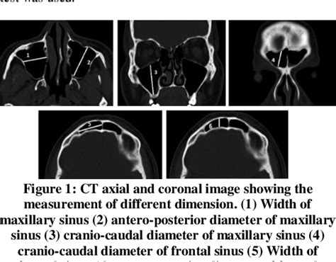 Table 1 From Measurement Of Different Dimension Of Maxillary And