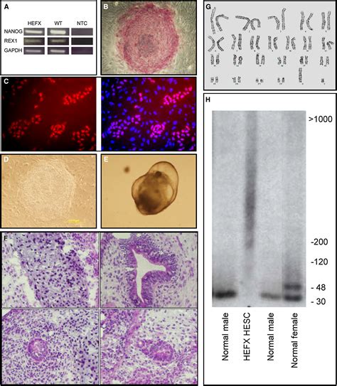 Fragile X Syndrome Southern Blot Analysis