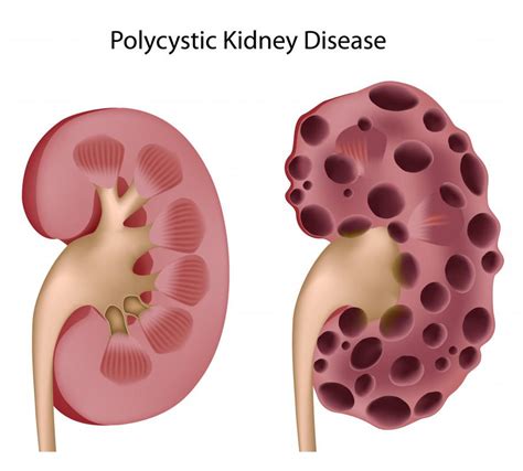 What Is Edema Of The Kidney With Pictures