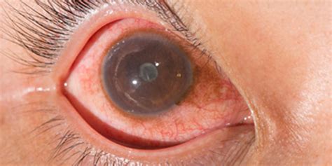 Symptoms Causes And Treatment Of Uveitis Neoretina Blog