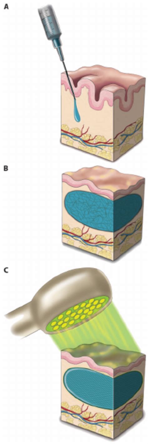 Injection of Photoactivated PEG-HA Hydrogel | Download Scientific Diagram