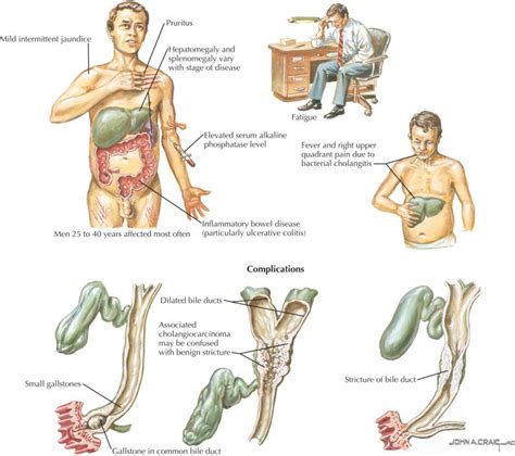 Primary Sclerosing Cholangitis Clinical Tree