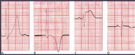 EKGs Ch 6 ACS Flashcards Quizlet