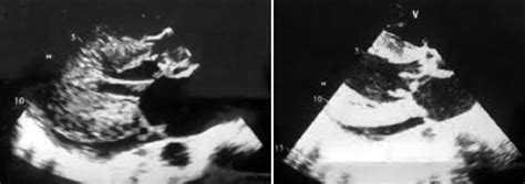 A 2d Echo Plax View Showing Subaortic Membrane With Marked Left