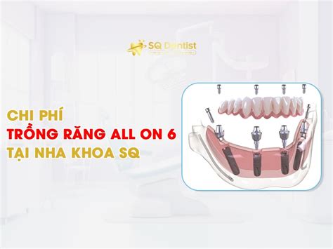 Chi Ph Tr Ng R Ng Implant All On T I H Ch Minh Nha Khoa Sq