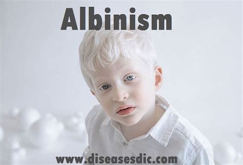 Albinism: causes, symptoms, treatment and prevention