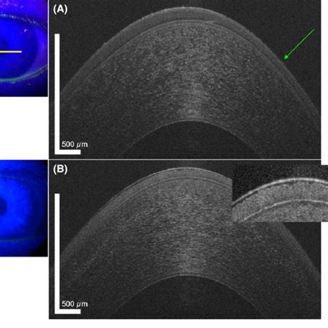 Ultrahigh Resolution Uhr Optical Coherence Tomography Oct